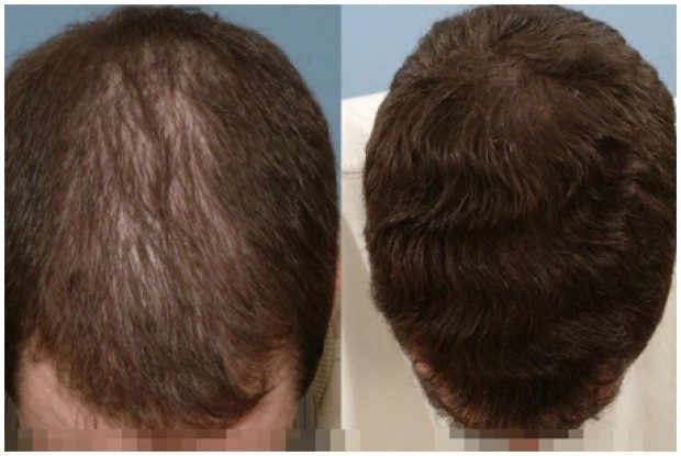 does finasteride make you look younger