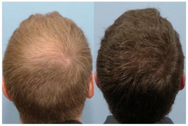 propecia before and after crown