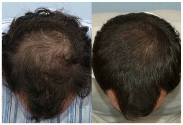 finasteride and minoxidil together reddit