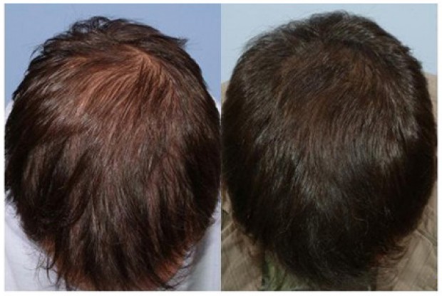 propecia before and after crown