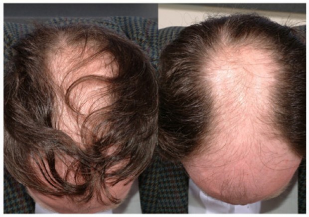 Images of a comb over - before and after