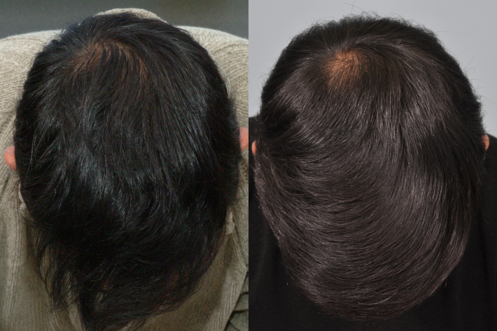 Minoxidil & Finasteride results after 10 years