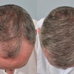 hair transplant 6 months post op before and after