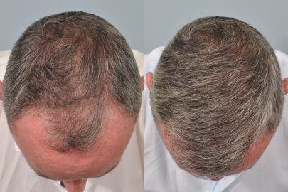 hair transplant 6 months post op before and after