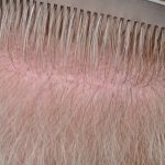 scarring after an FUT hair transplant