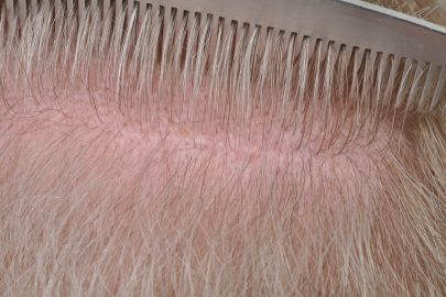 scarring after an FUT hair transplant