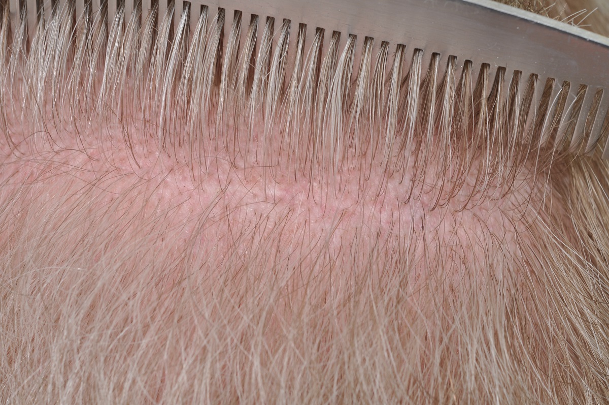scarring after an FUT hair transplant