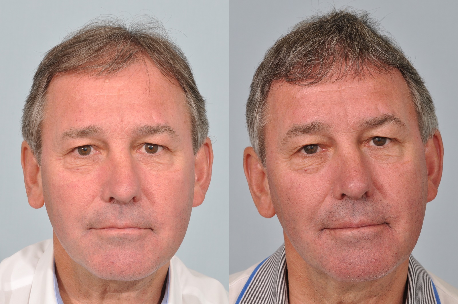 Bryan Robson Hair Transplant Update One Year Post Surgery