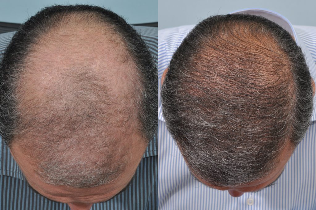 Hair restoration results at HRBR
