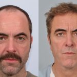 James Nesbitt hair transplant before and after