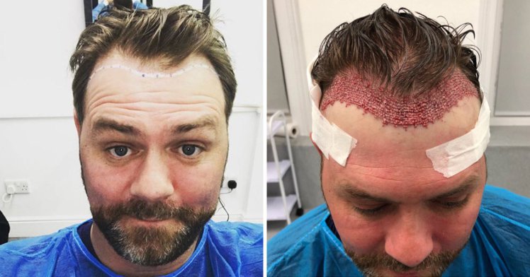 brian mcfadden hair transplant