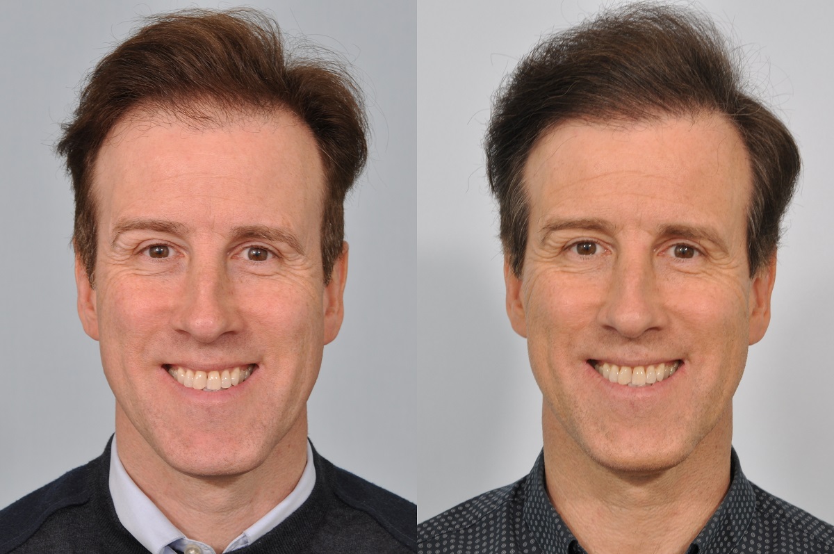 Du Beke, Anton (before and after hair transplant)