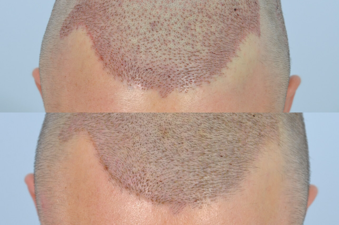 does a hair transplant hurt?