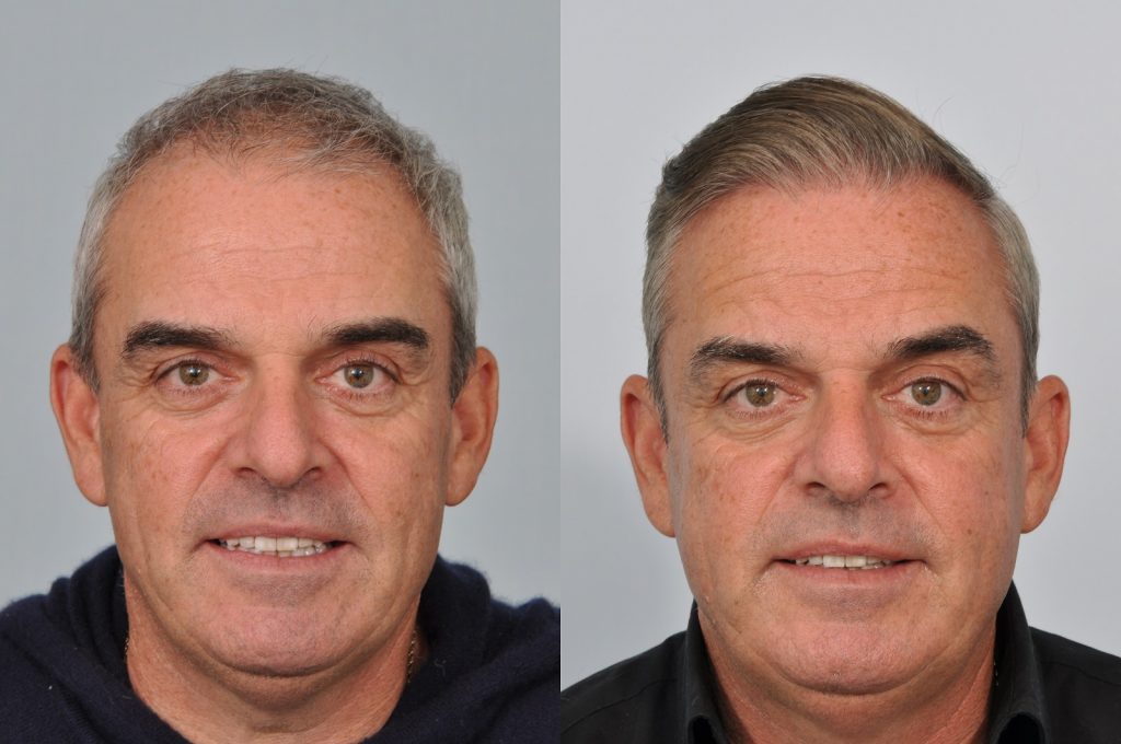 Paul McGinley hair transplant before and after
