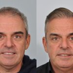 Paul McGinley hair transplant before and after