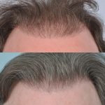 hair transplant repair case study