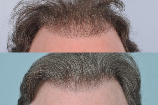 hair transplant repair case study