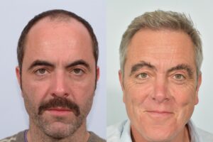 James Nesbitt before and after Sept 2021.