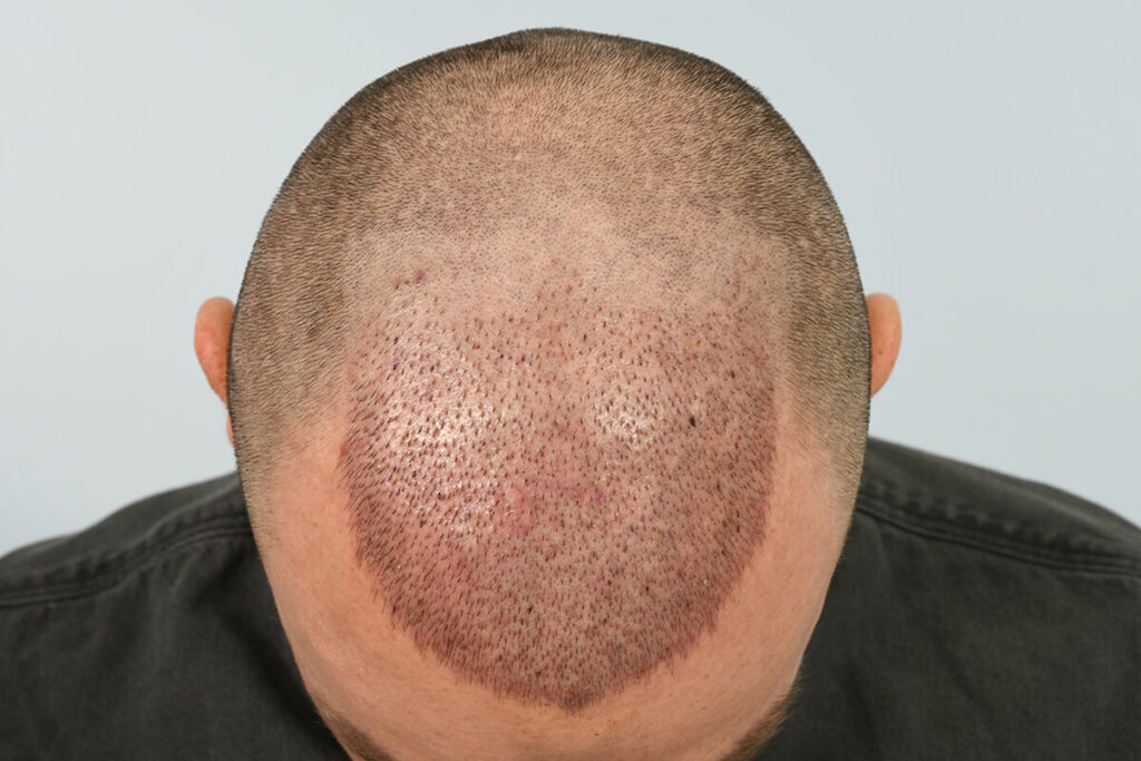Men Immediately Post-op – FUT and FUE - Hair Transplant Clinic UK