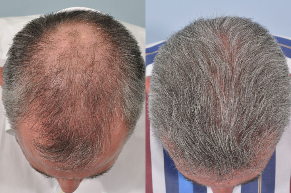 Hair Transplants – Before and After - Hair Transplant Clinic UK