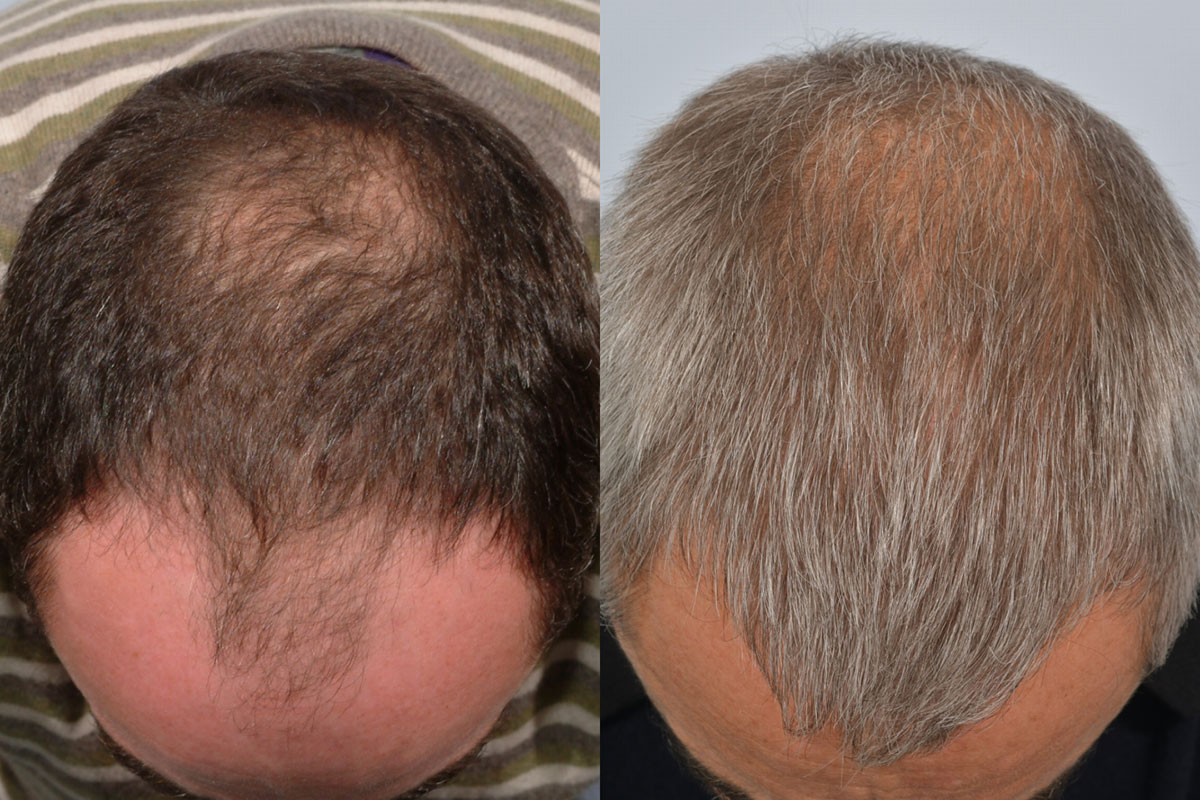 Hair Transplant After 10 Years Reddit Hair Transplant 10 Years Later - HRBR, Ireland