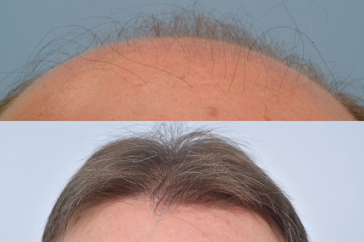 Hair Transplant After 10 Years Reddit Hair Transplant 10 Years Later - HRBR, Ireland