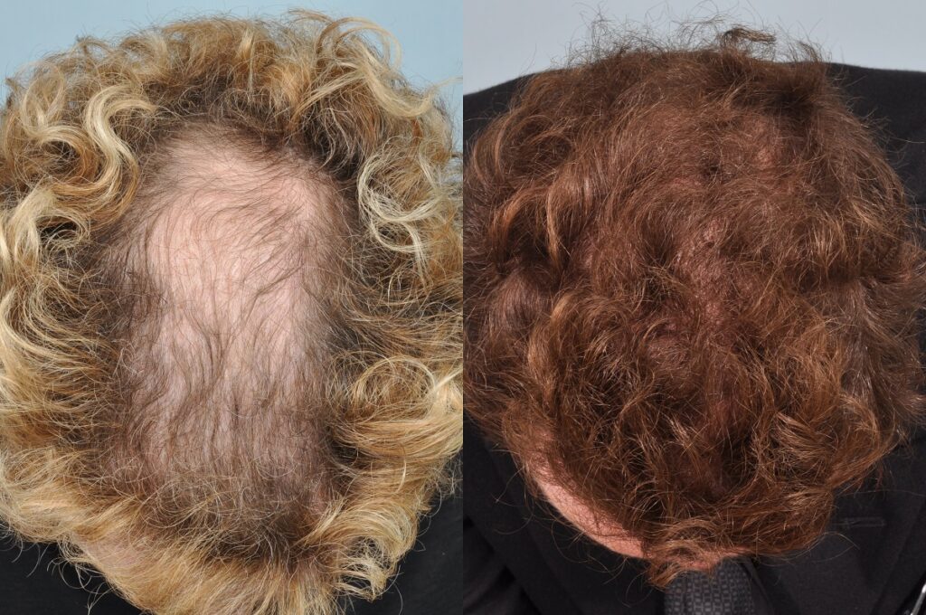 Hair transplant curly hair: before & after