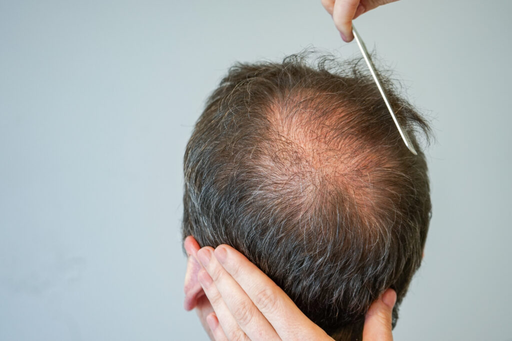 male pattern baldness