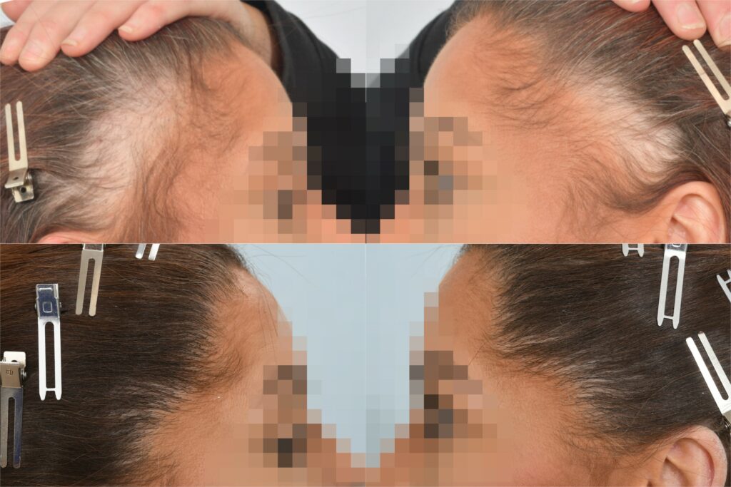 Traction Alopecia - Before & After Transplant