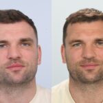 Tadhg Beirne Hair Transplant (Latest)