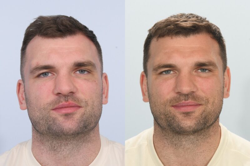 Tadhg Beirne Hair Transplant (Latest)