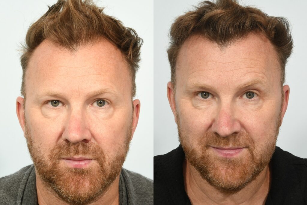 Jason Byrne Hair Transplant. Before & After. 6 months post-op.