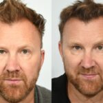 Jason Byrne Hair Transplant. Before & After. 6 months post-op.