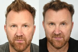 Jason Byrne Hair Transplant. Before & After. 6 months post-op.