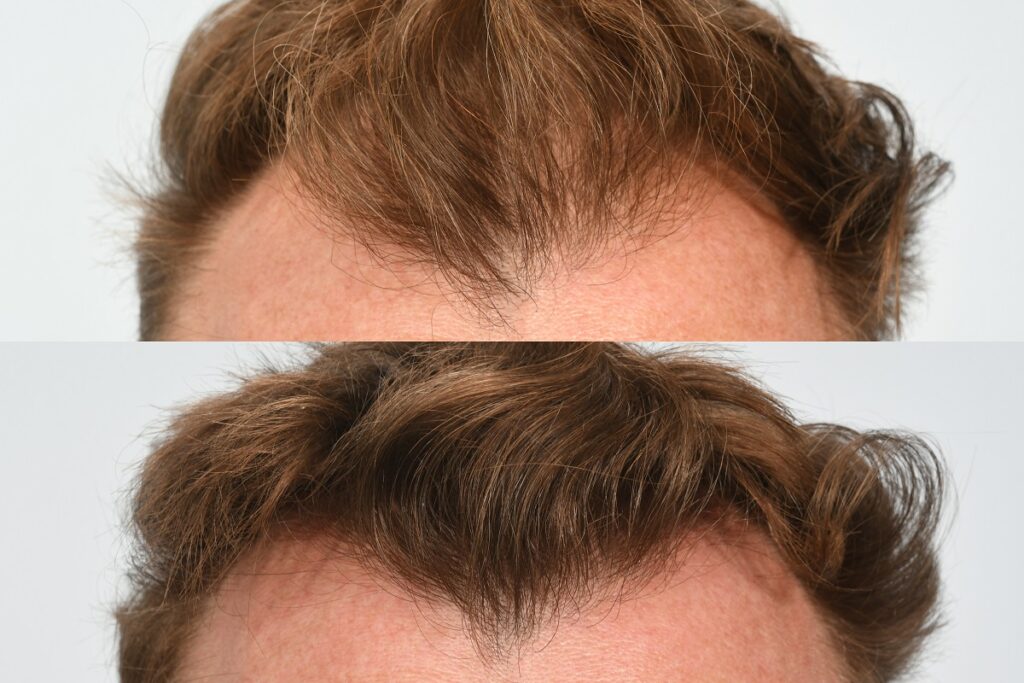 Jason Byrne. 6 months post op - hairline.