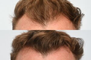 Jason Byrne. 6 months post op - hairline.