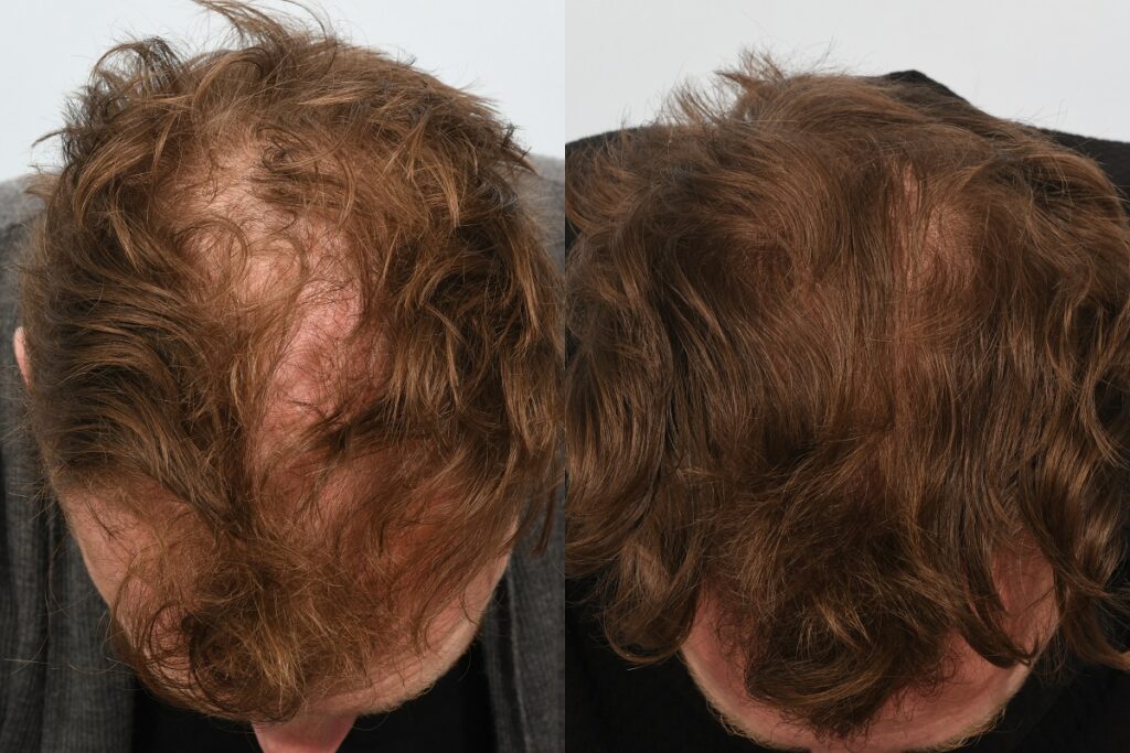 Jason Byrne. 6 months post op - crown.