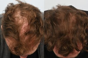 Jason Byrne. 6 months post op - crown.