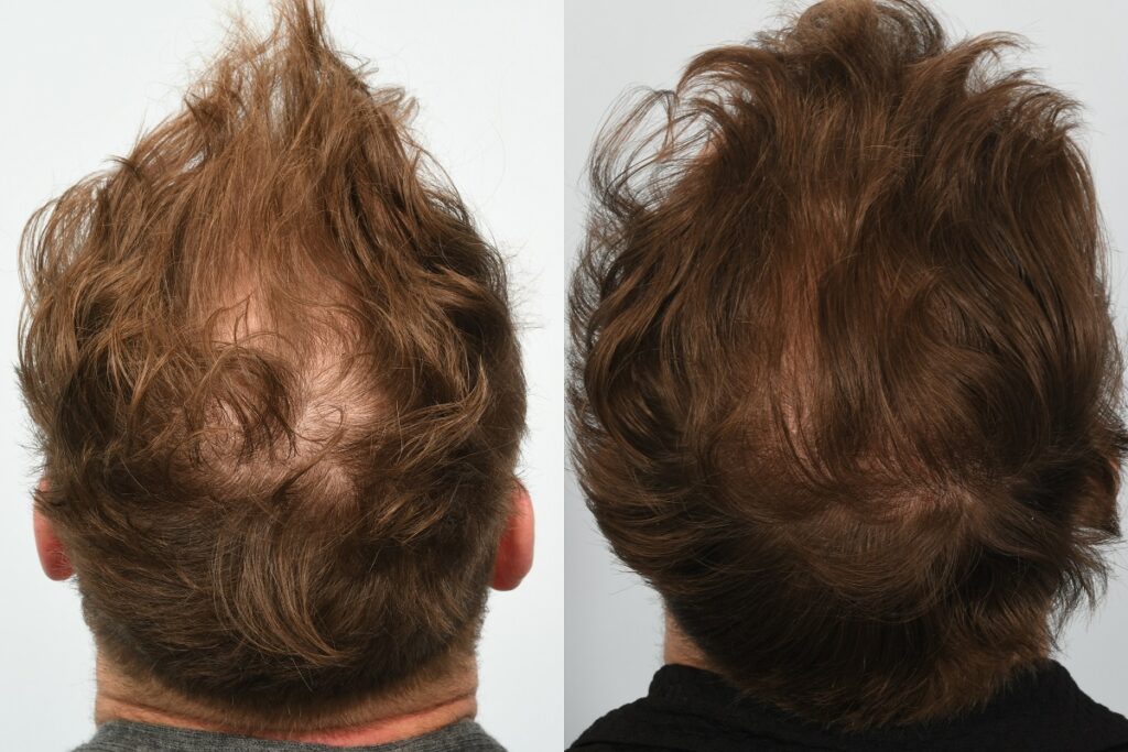 Jason Byrne. 6 months post op - crown 2.