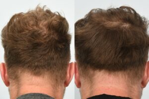Jason Byrne. 6 months post op - back of head.