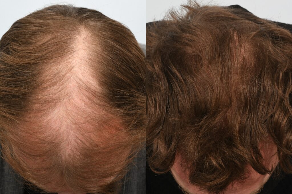 Jason Byrne. 6 months post op - top of head.