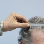 Hair loss review