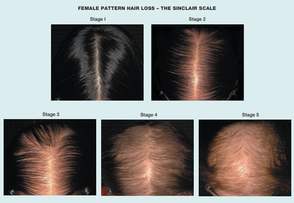 sinclair scale of female pattern hair loss